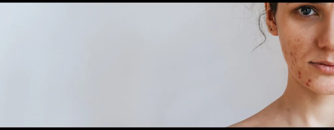 Jaki peeling do cery trądzikowej? Odkryj skuteczne rozwiązania dla skóry