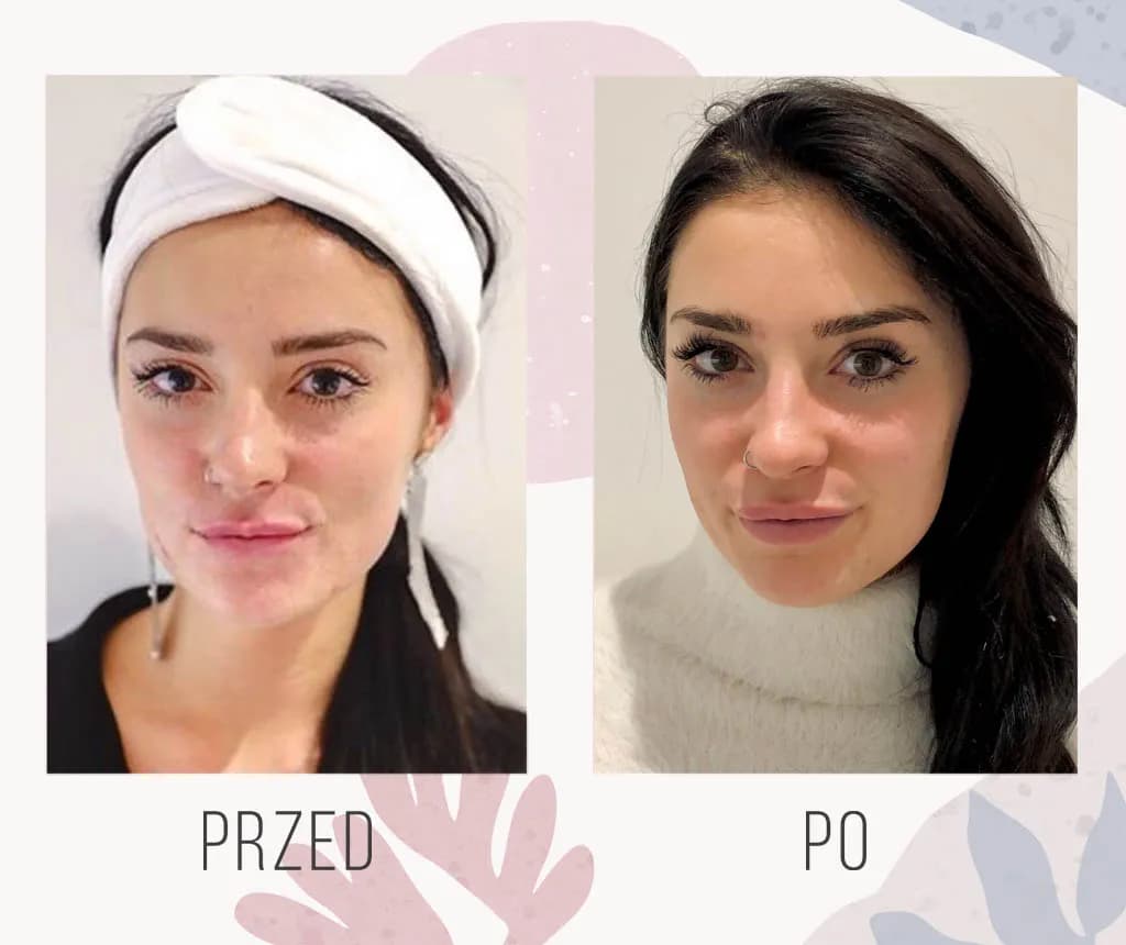 Usta botoks czy kwas hialuronowy: Który zabieg naprawdę działa?