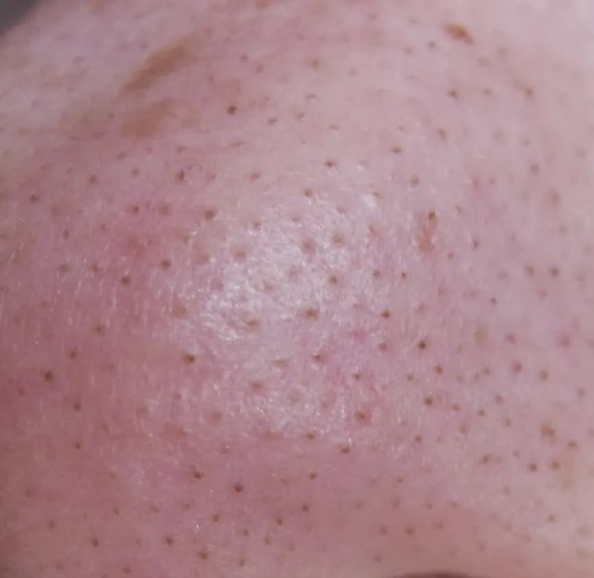 Jak wygląda zapchana cera i jak skutecznie z nią walczyć