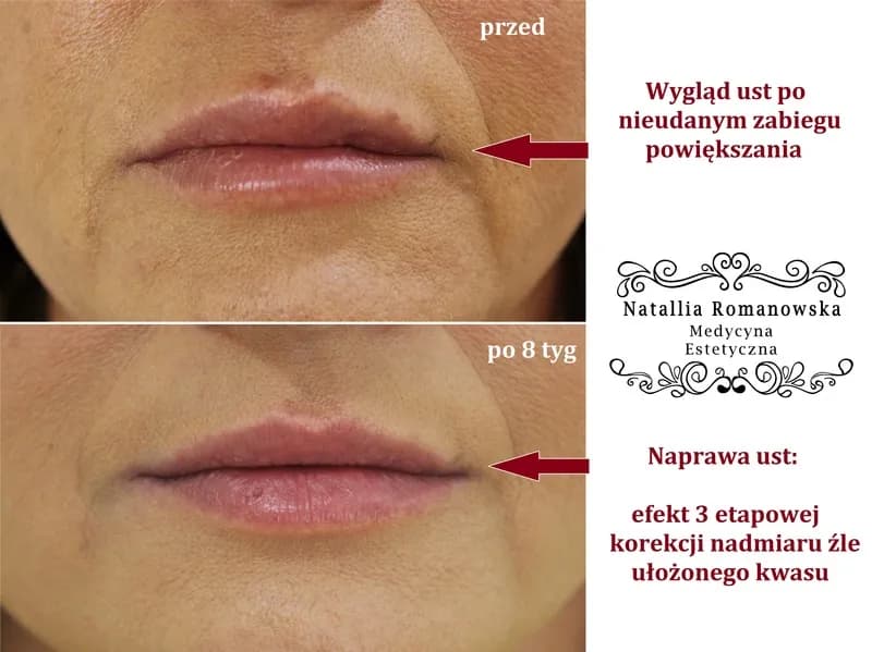 Czy można się całować po powiększaniu ust? Dowiedz się, co musisz wiedzieć